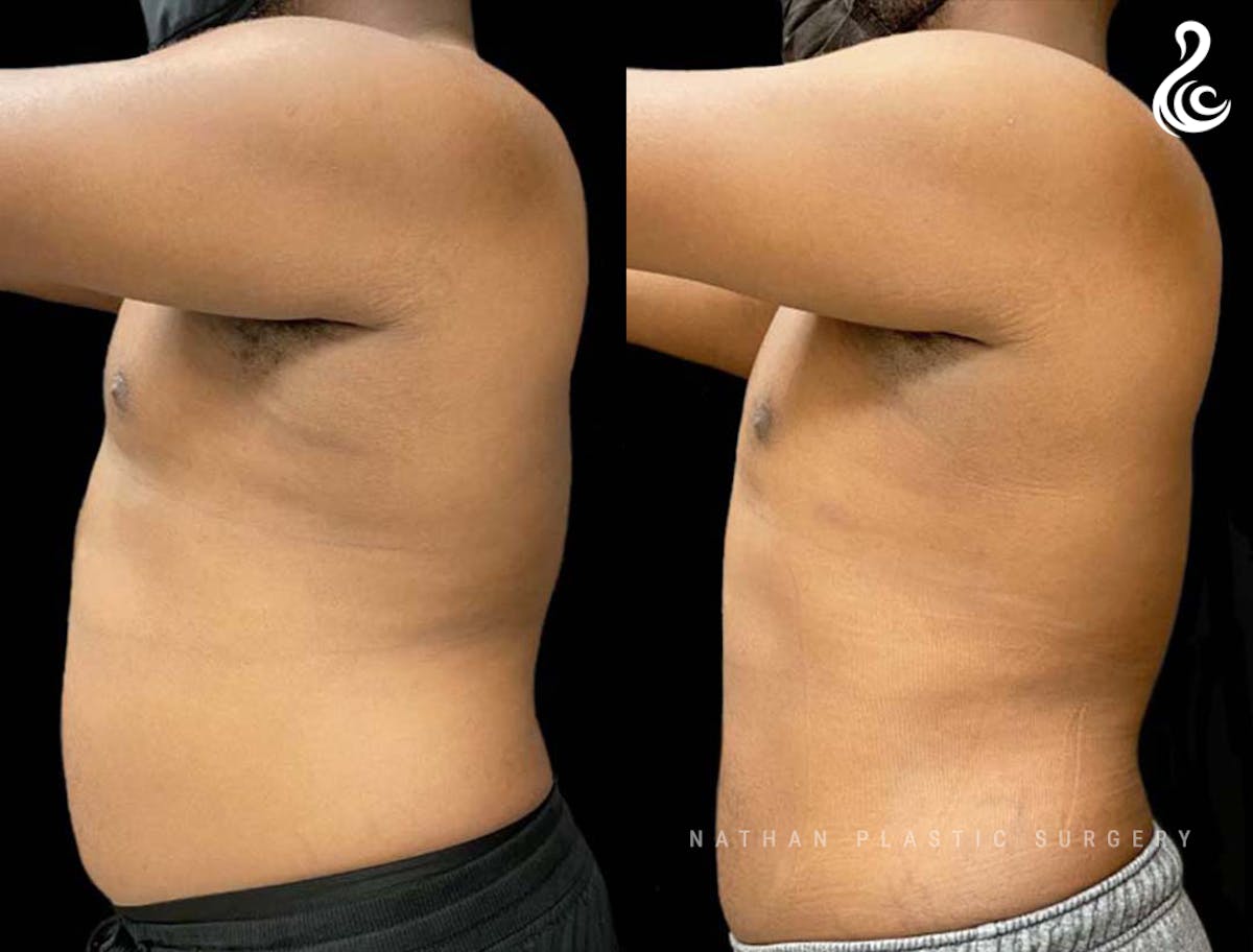 Male Liposuction Before & After Gallery - Patient 231869 - Image 3