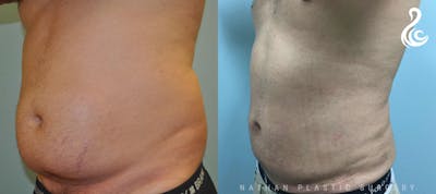 Male Liposuction Before & After Gallery - Patient 361497 - Image 1