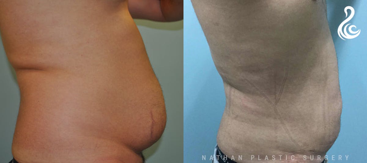Male Liposuction Before & After Gallery - Patient 361497 - Image 2