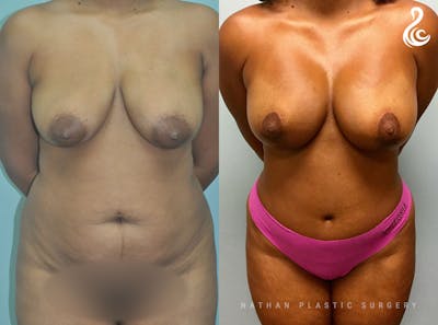 Mommy Makeover Before & After Gallery - Patient 408271 - Image 1