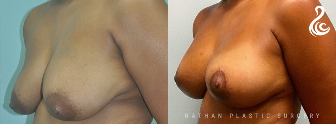 Mommy Makeover Before & After Gallery - Patient 408271 - Image 2