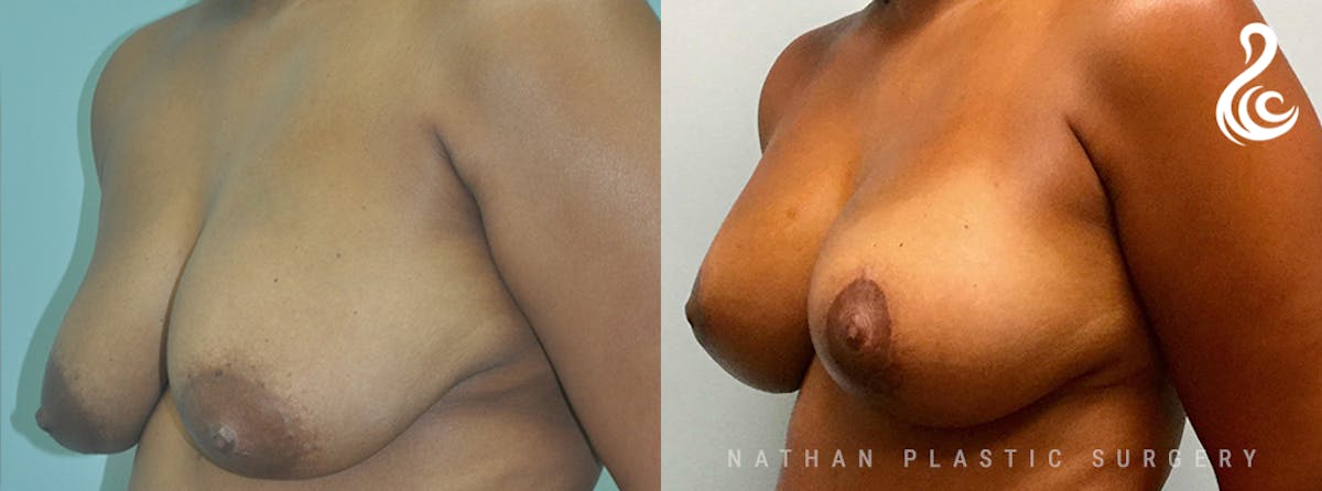 Mommy Makeover Before & After Gallery - Patient 408271 - Image 2