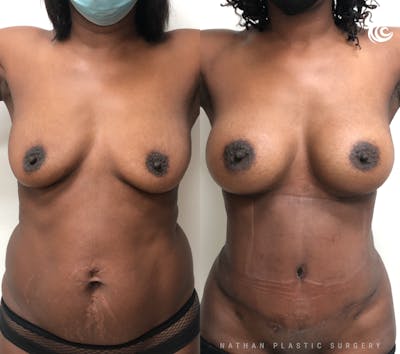 Mommy Makeover Before & After Gallery - Patient 240721 - Image 1