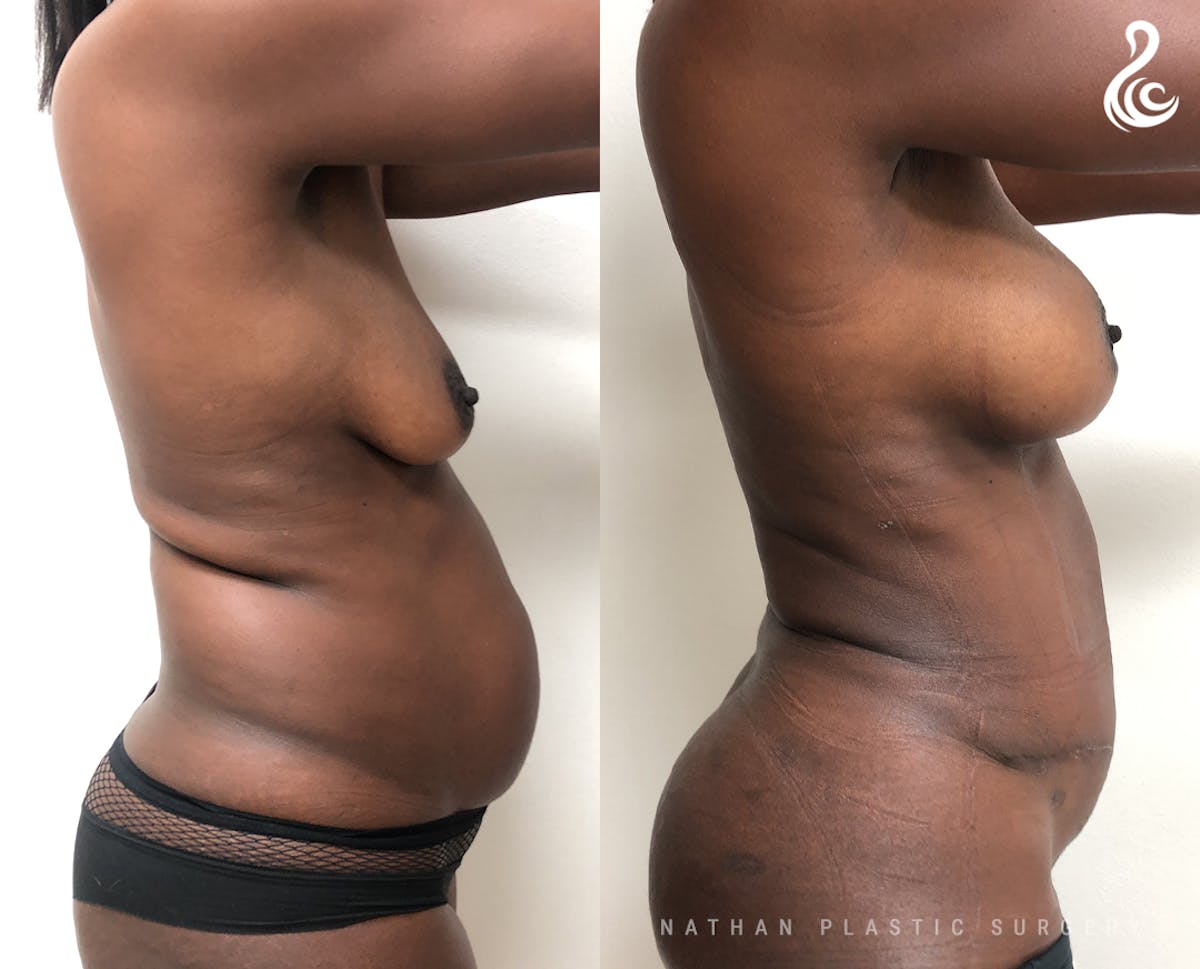 Mommy Makeover Before & After Gallery - Patient 240721 - Image 2