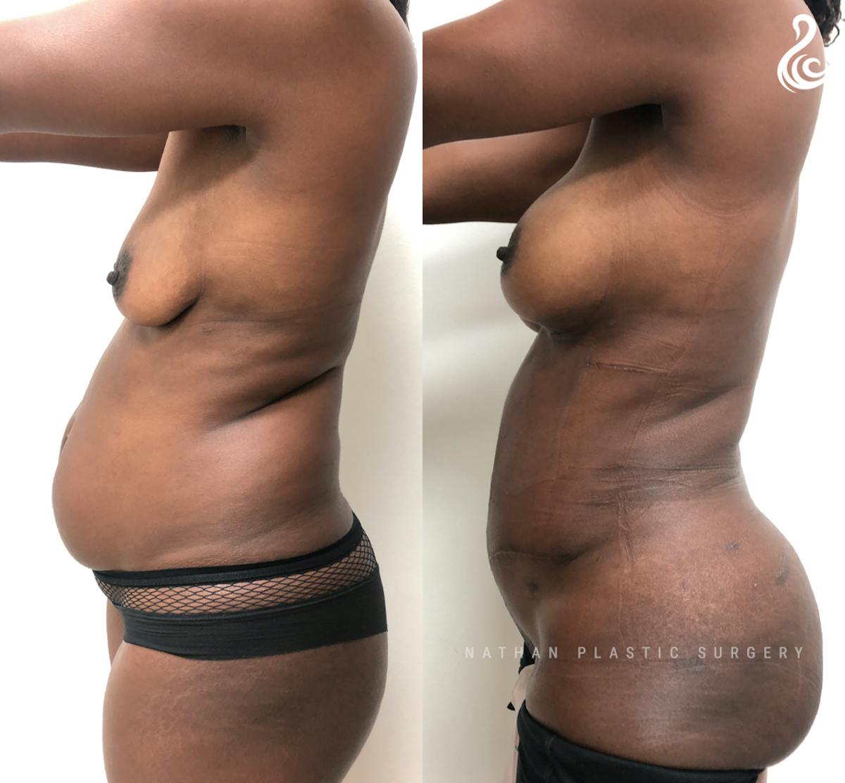 Mommy Makeover Before & After Gallery - Patient 240721 - Image 3