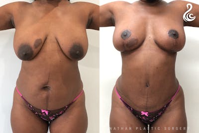 Mommy Makeover Before & After Gallery - Patient 421159 - Image 1