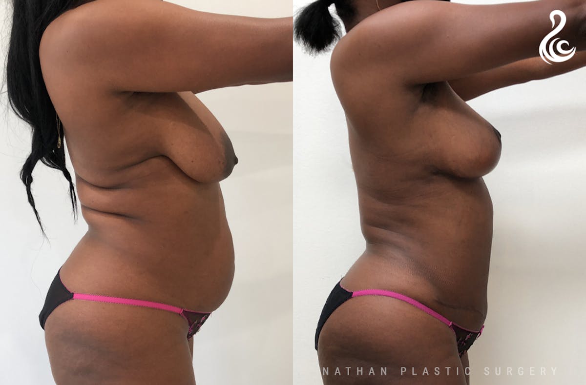 Mommy Makeover Before & After Gallery - Patient 421159 - Image 2