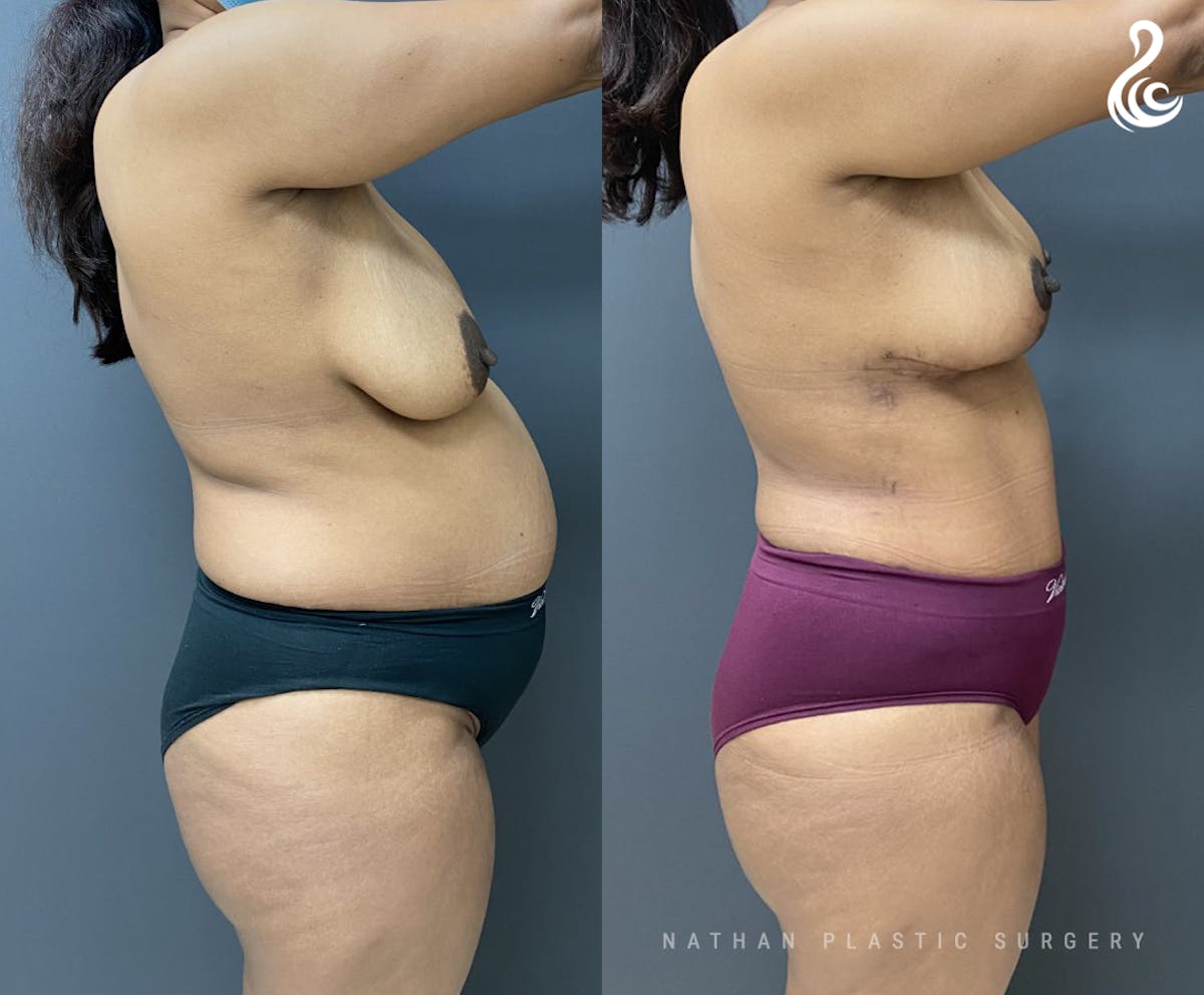 Mommy Makeover Before & After Gallery - Patient 309357 - Image 2