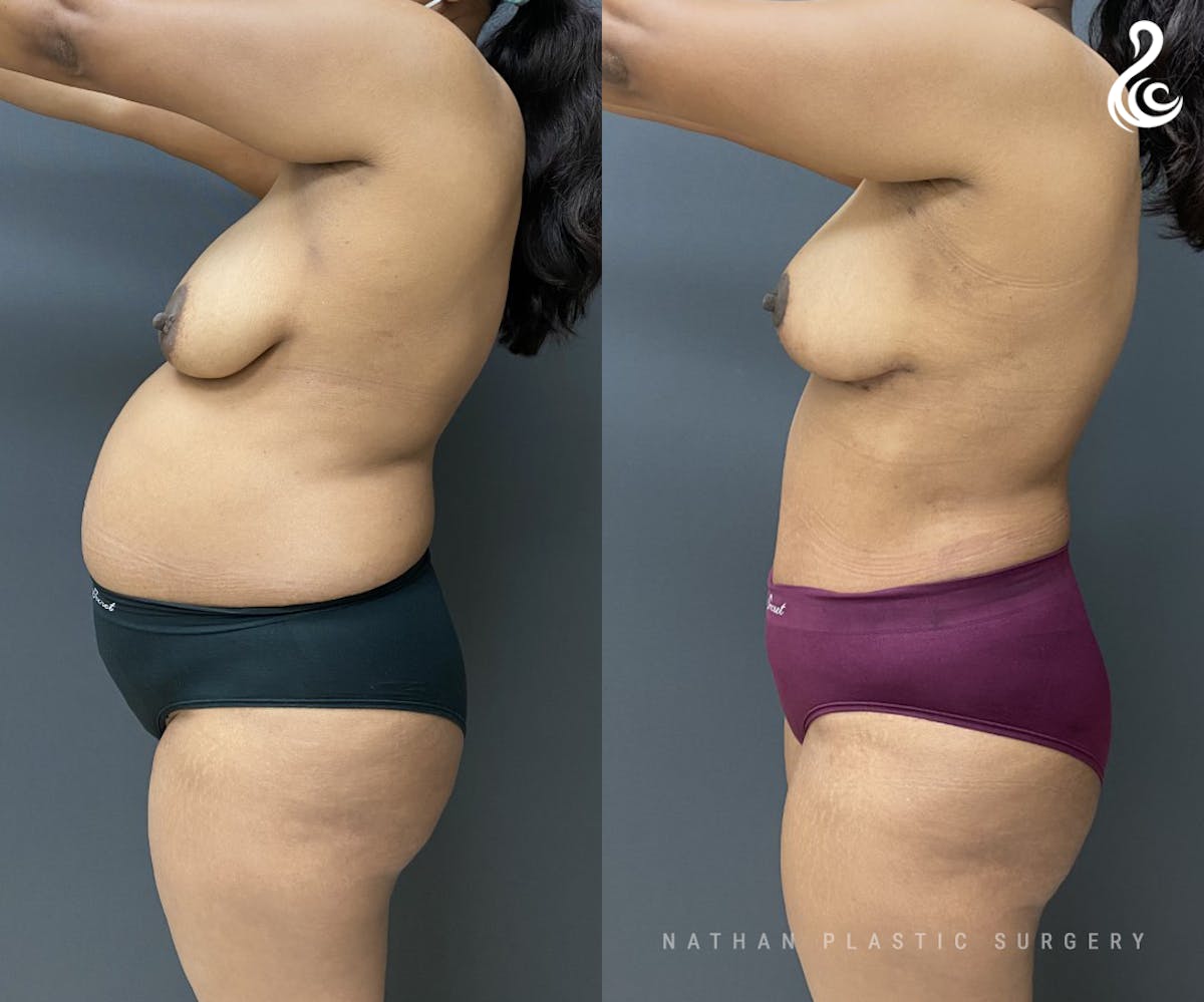 Mommy Makeover Before & After Gallery - Patient 309357 - Image 3