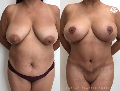 Mommy Makeover Before & After Gallery - Patient 153621 - Image 1