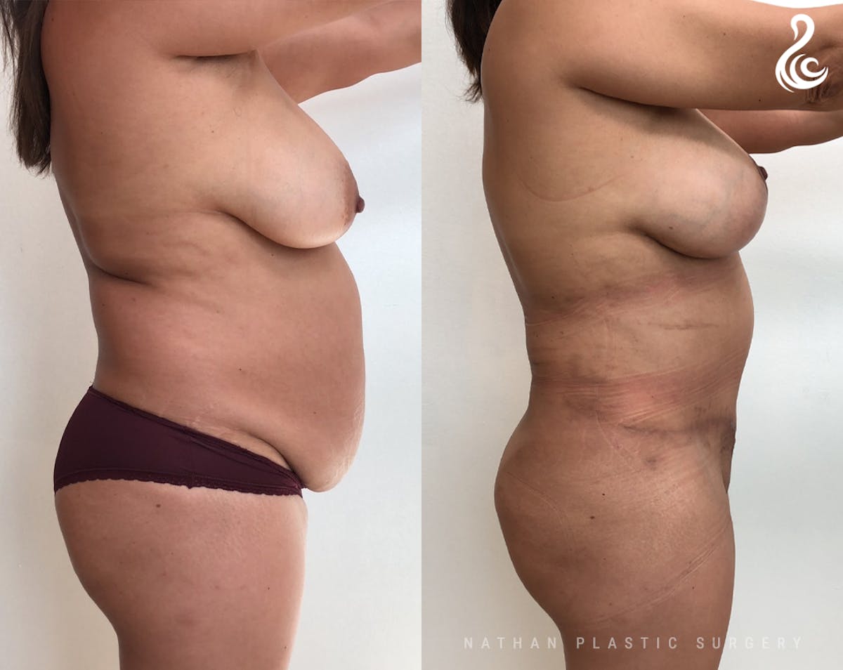 Mommy Makeover Before & After Gallery - Patient 153621 - Image 2