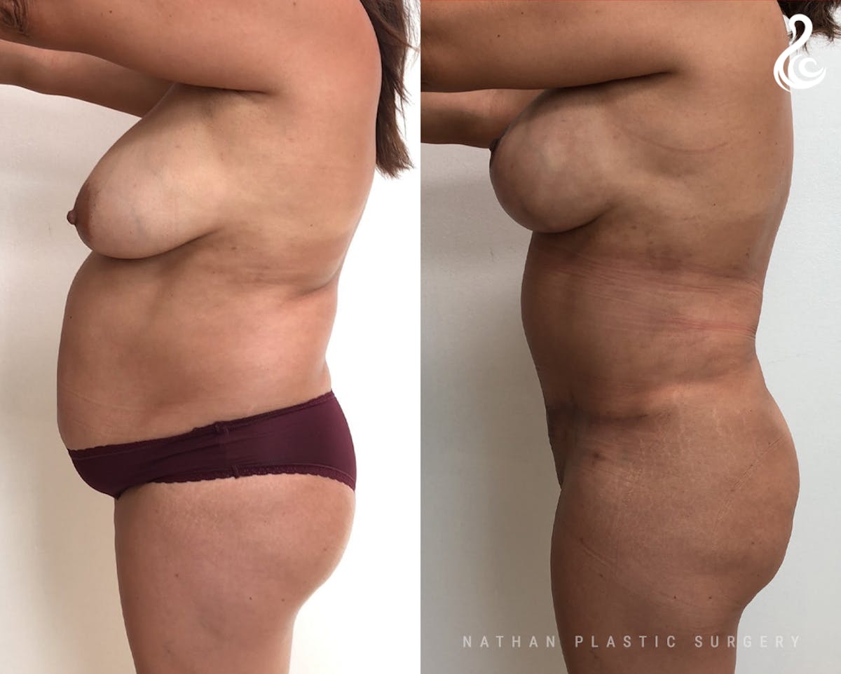 Mommy Makeover Before & After Gallery - Patient 153621 - Image 3