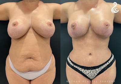 Mommy Makeover Before & After Gallery - Patient 153930 - Image 1