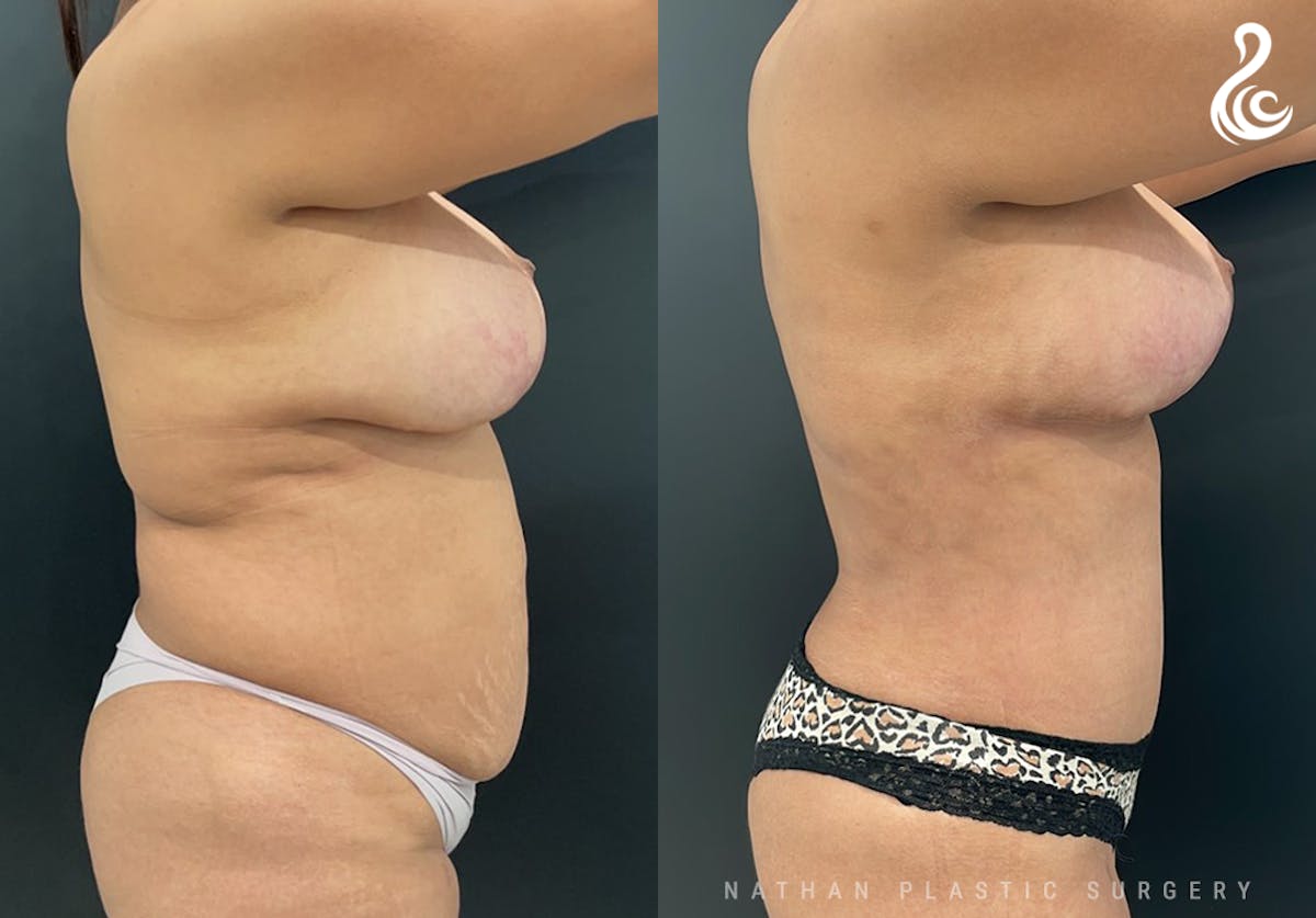 Mommy Makeover Before & After Gallery - Patient 153930 - Image 2