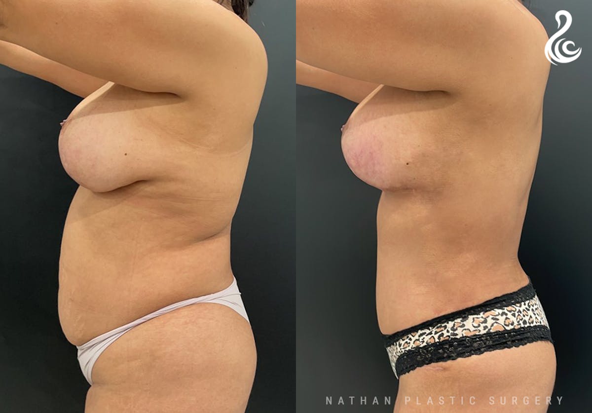 Mommy Makeover Before & After Gallery - Patient 153930 - Image 3