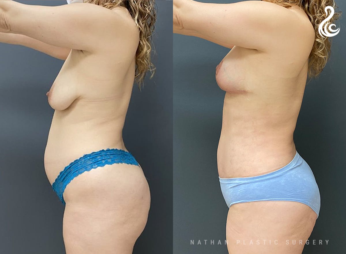 Mommy Makeover Before & After Gallery - Patient 927476 - Image 3