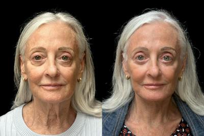 Facelift Before & After Gallery - Patient 265999 - Image 1