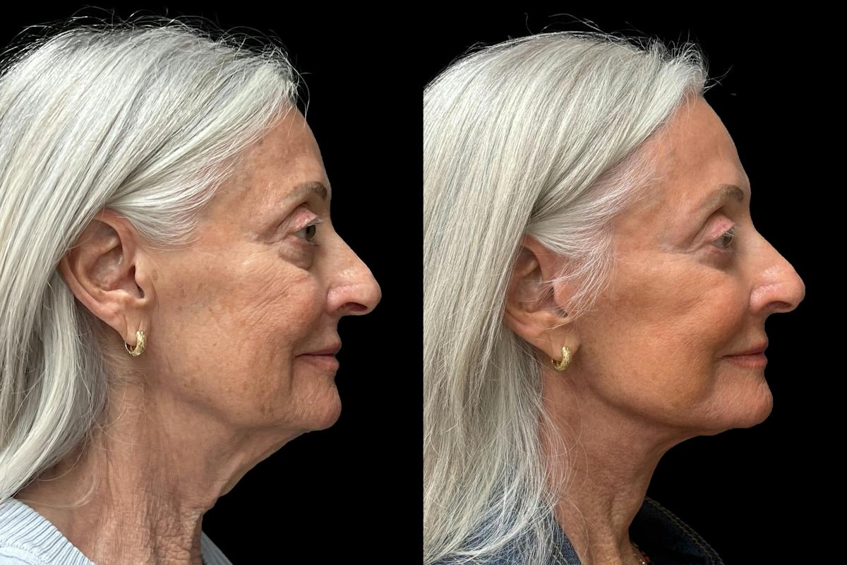 Facelift Before & After Gallery - Patient 265999 - Image 2