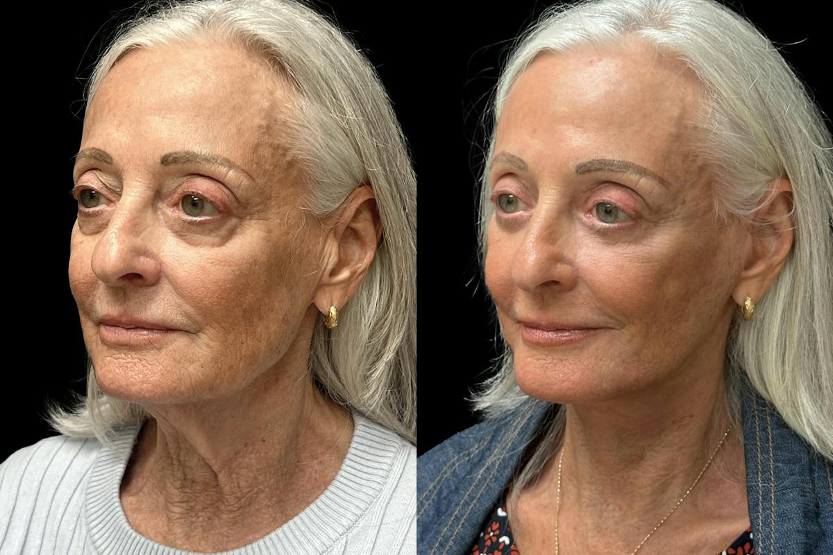 Facelift Before & After Gallery - Patient 265999 - Image 3