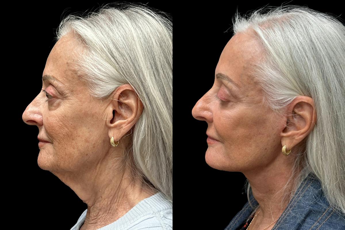 Facelift Before & After Gallery - Patient 265999 - Image 4