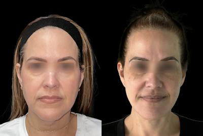 Facelift Before & After Gallery - Patient 123420 - Image 1