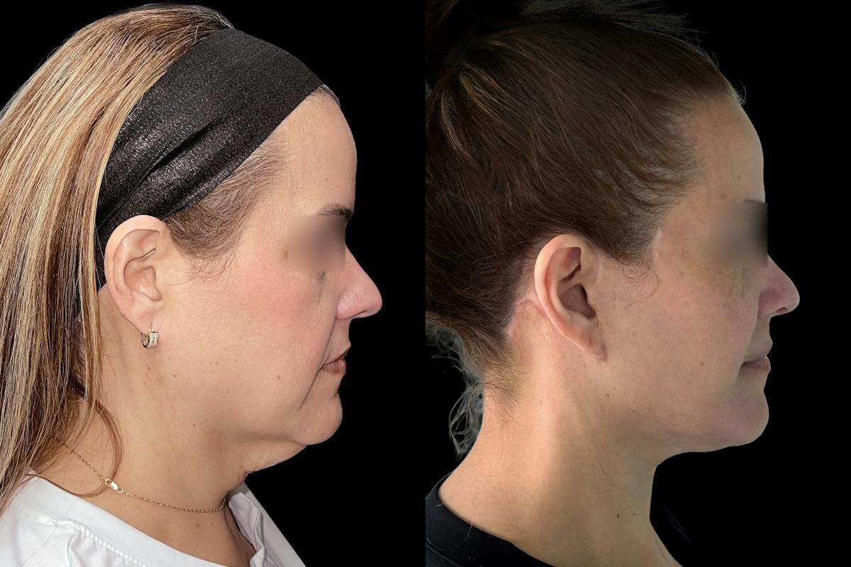 Facelift Before & After Gallery - Patient 123420 - Image 3