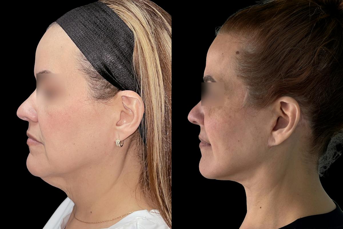 Facelift Before & After Gallery - Patient 123420 - Image 4
