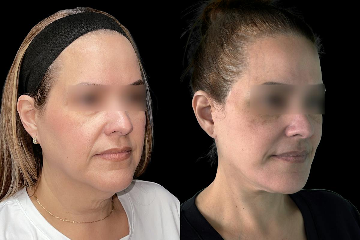 Facelift Before & After Gallery - Patient 123420 - Image 2