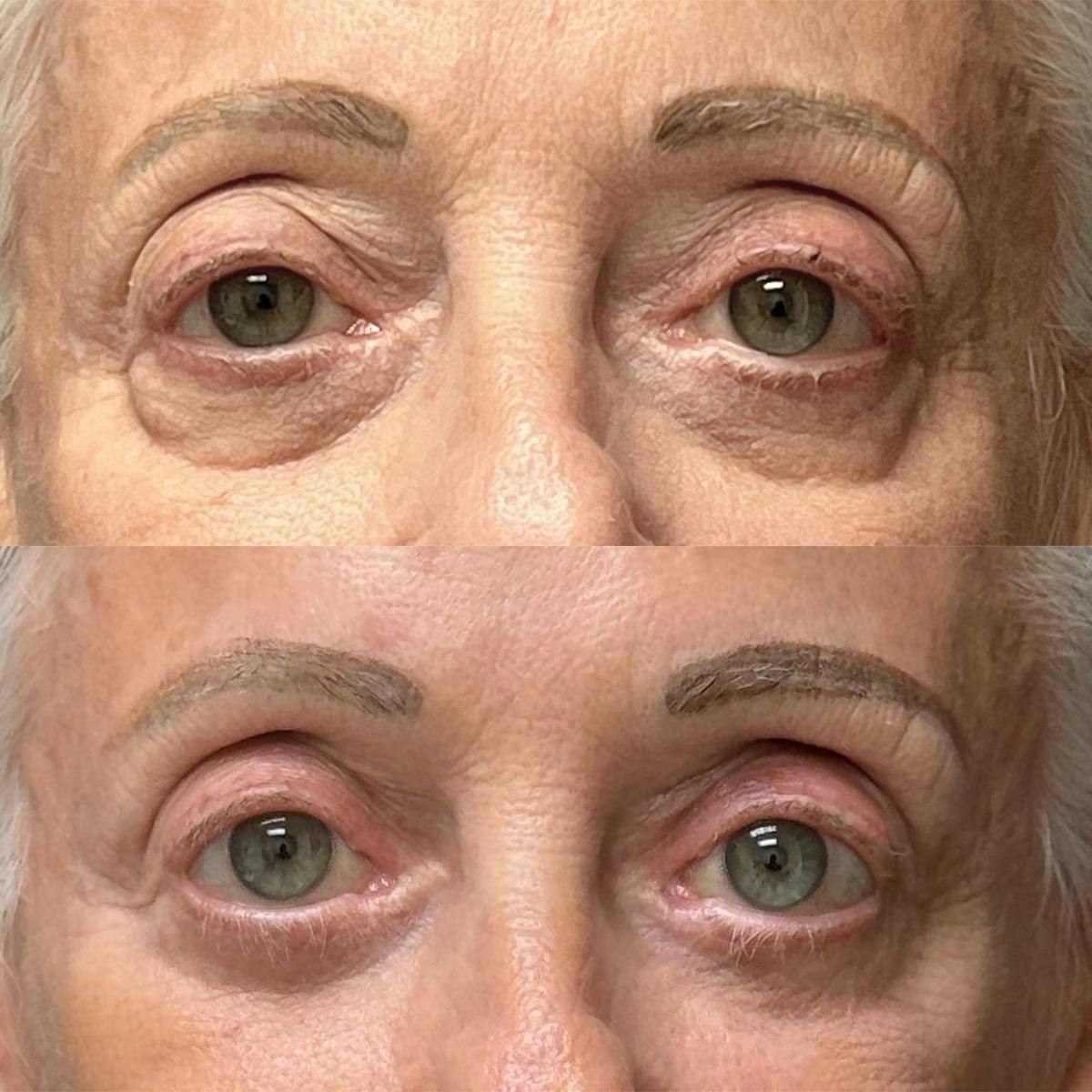 Eyelid Surgery Before & After Gallery - Patient 214539 - Image 1