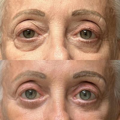 Eyelid Surgery Before & After Gallery - Patient 214539 - Image 1