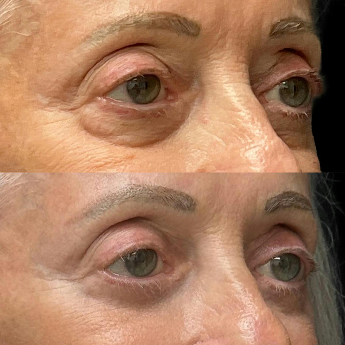 Eyelid Surgery Before & After Gallery - Patient 214539 - Image 2
