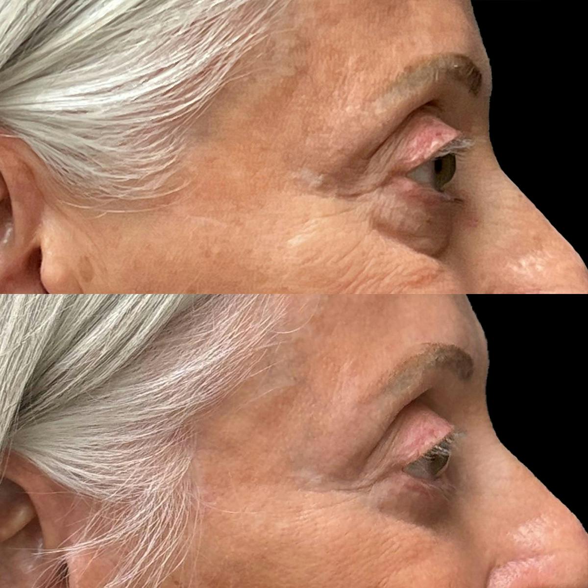 Eyelid Surgery Before & After Gallery - Patient 214539 - Image 3