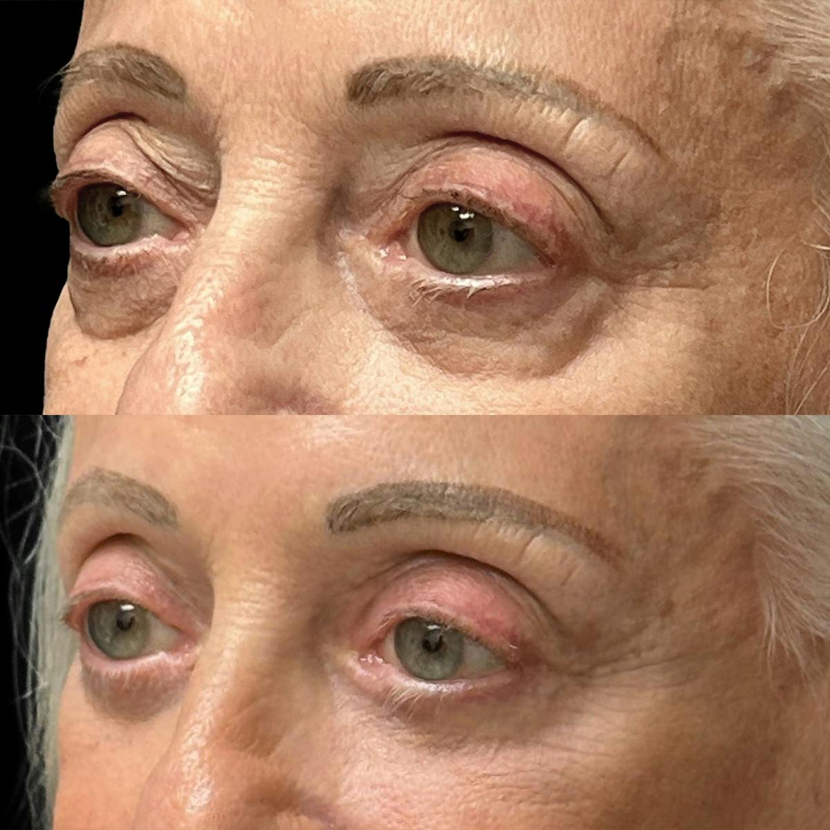 Eyelid Surgery Before & After Gallery - Patient 214539 - Image 4