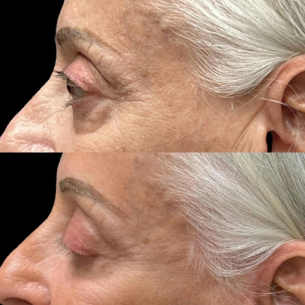 Eyelid Surgery Before & After Gallery - Patient 214539 - Image 5