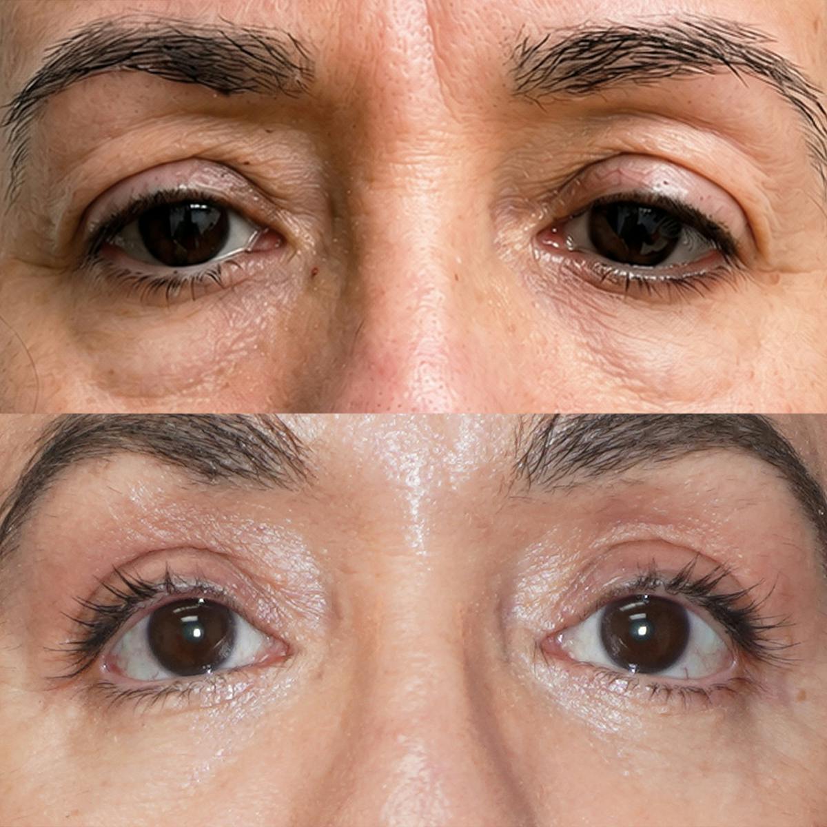 Eyelid Surgery Before & After Gallery - Patient 407230 - Image 1