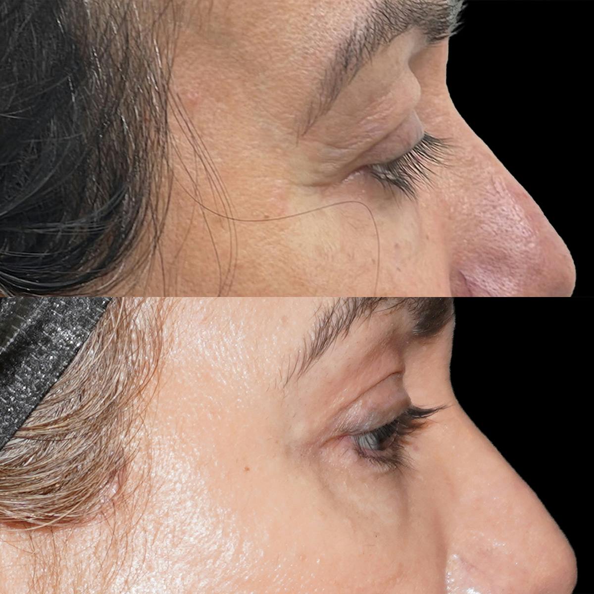 Eyelid Surgery Before & After Gallery - Patient 407230 - Image 2