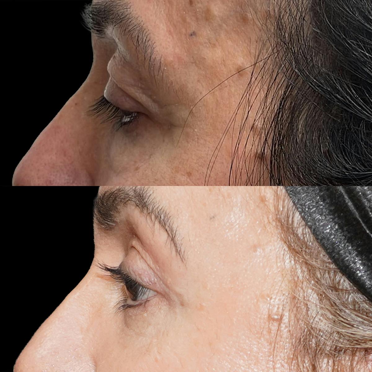 Eyelid Surgery Before & After Gallery - Patient 407230 - Image 3