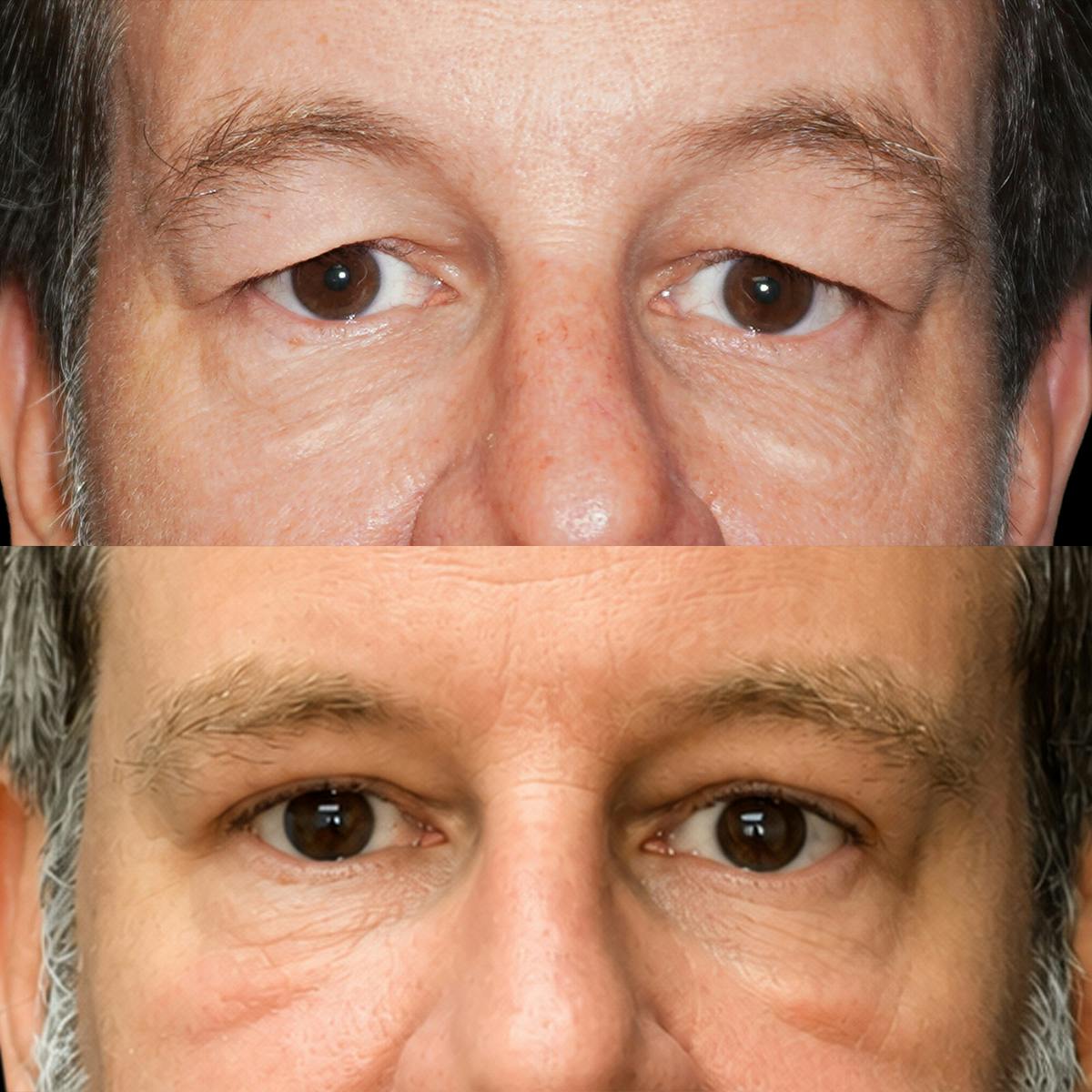 Eyelid Surgery Before & After Gallery - Patient 206698 - Image 1