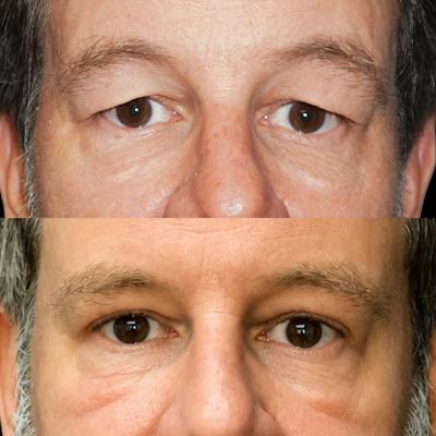 Eyelid Surgery Before & After Gallery - Patient 206698 - Image 1