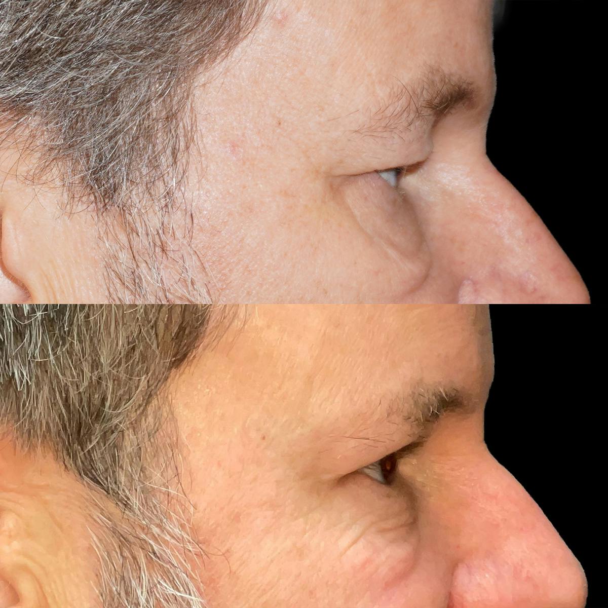 Eyelid Surgery Before & After Gallery - Patient 206698 - Image 2