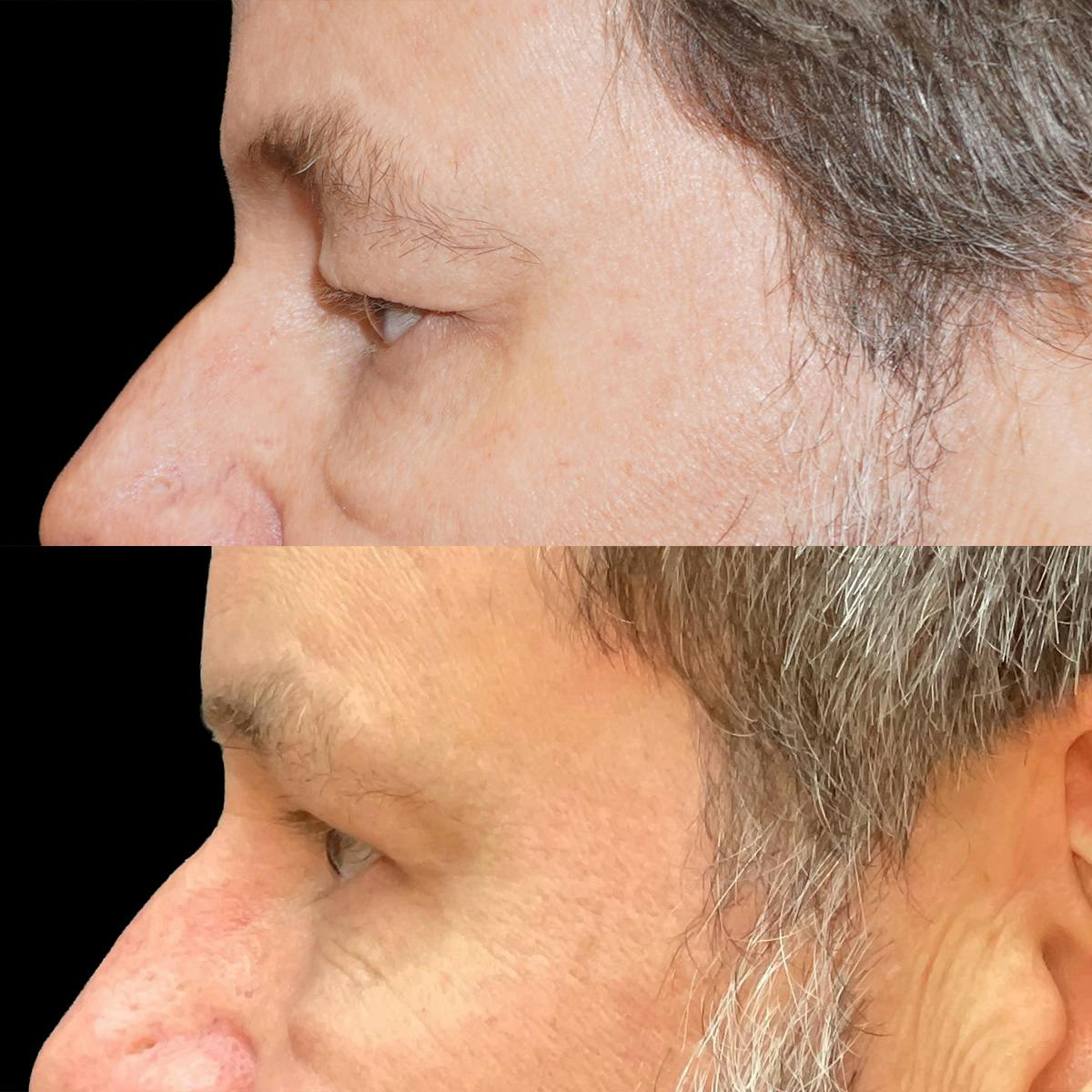 Eyelid Surgery Before & After Gallery - Patient 206698 - Image 3
