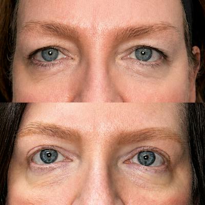 Eyelid Surgery Before & After Gallery - Patient 357627 - Image 1