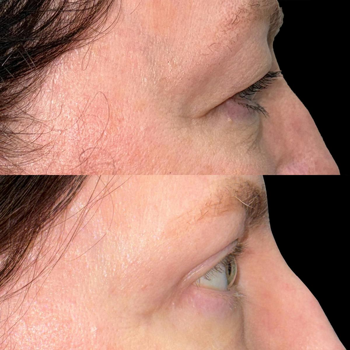 Eyelid Surgery Before & After Gallery - Patient 357627 - Image 2