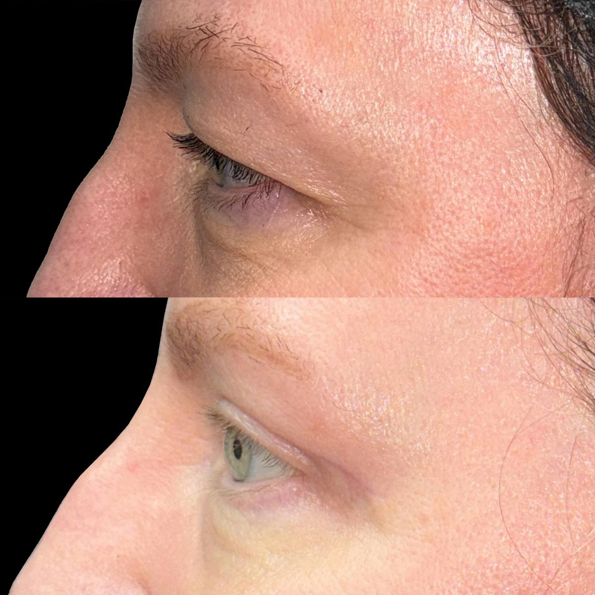 Eyelid Surgery Before & After Gallery - Patient 357627 - Image 3
