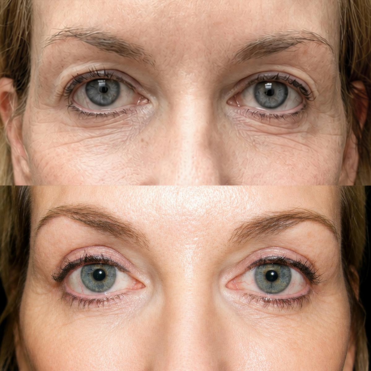 Eyelid Surgery Before & After Gallery - Patient 217120 - Image 1