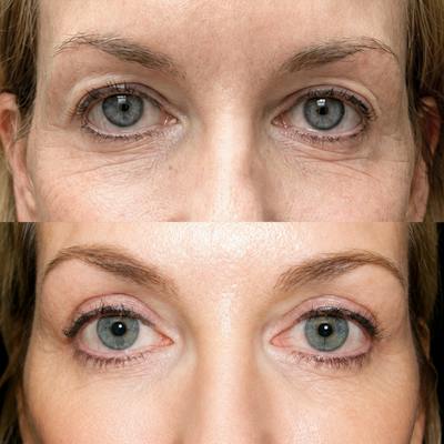 Eyelid Surgery Before & After Gallery - Patient 217120 - Image 1