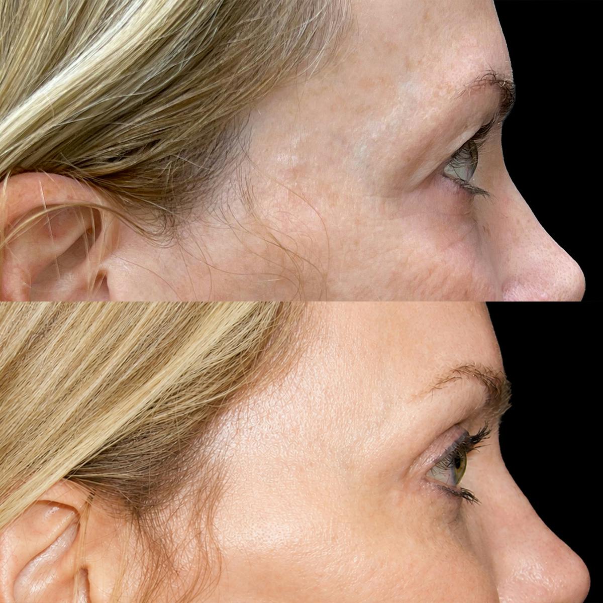 Eyelid Surgery Before & After Gallery - Patient 217120 - Image 2