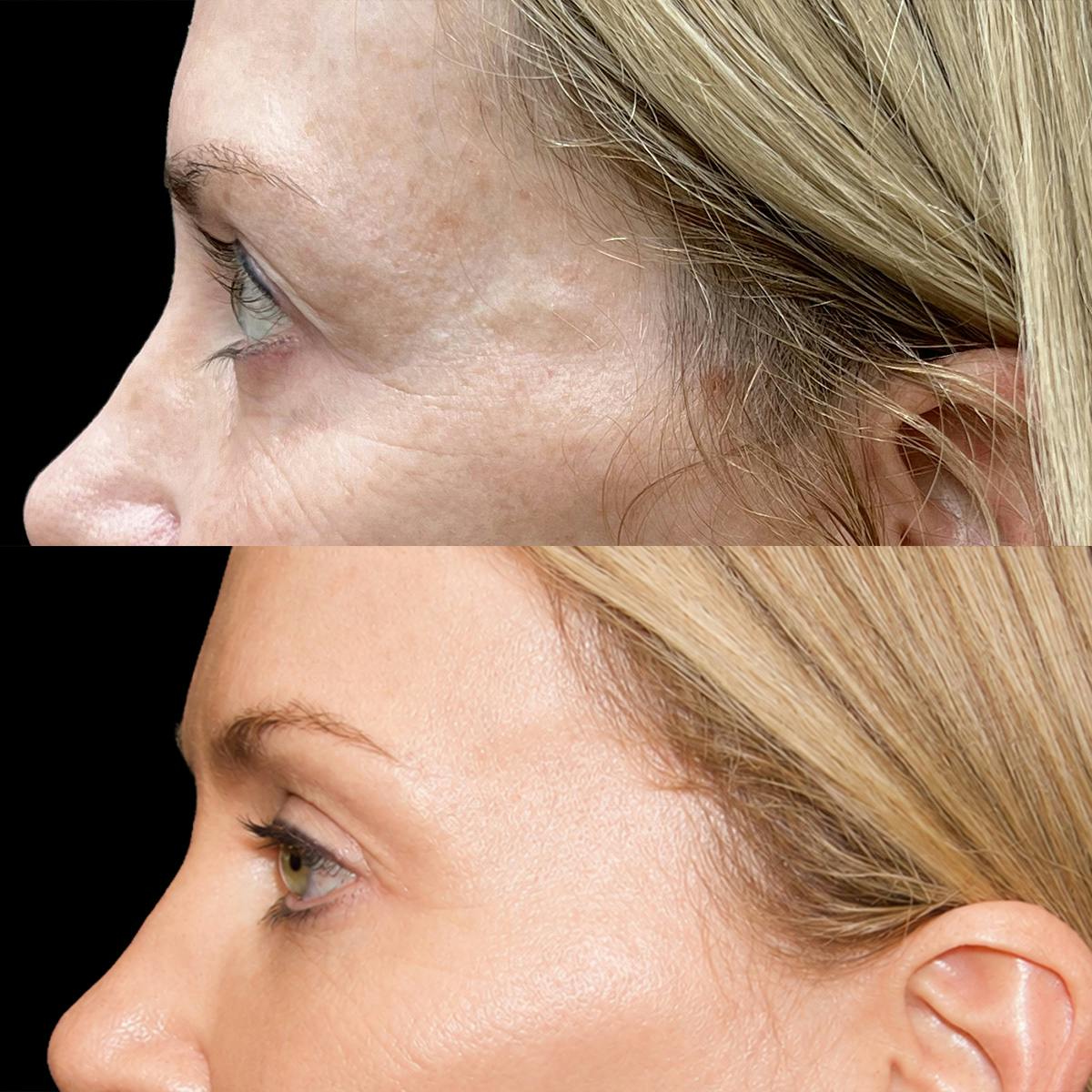 Eyelid Surgery Before & After Gallery - Patient 217120 - Image 3