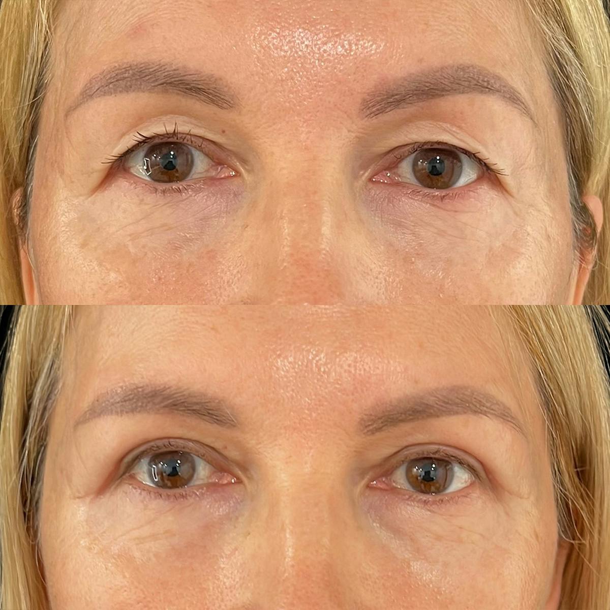 Eyelid Surgery Before & After Gallery - Patient 139637 - Image 1