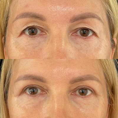 Eyelid Surgery Before & After Gallery - Patient 139637 - Image 1